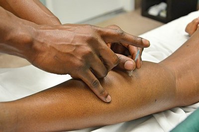 Foto mostra a aplicação de uma agulha de acupuntura no braço de um homem